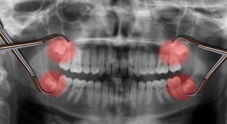 A dental x-ray highlighting a patient’s wisdom teeth